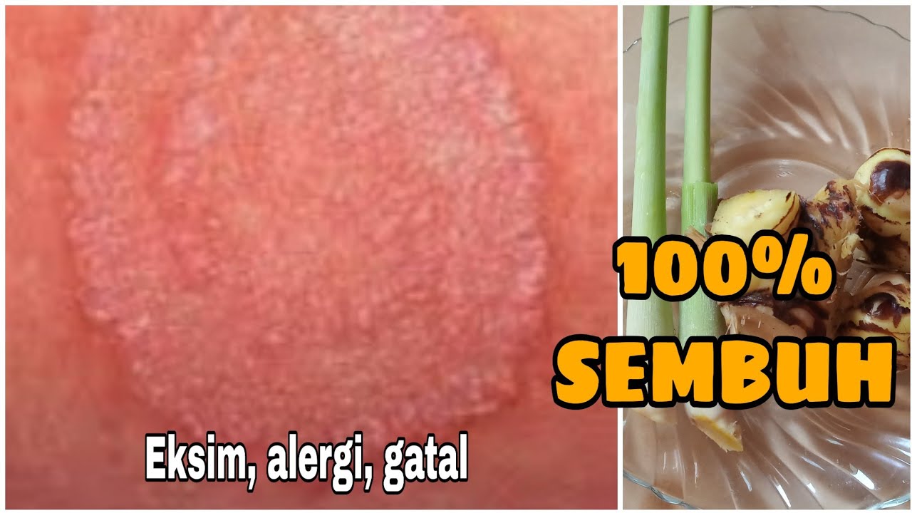 CARA MENGOBATI EKSIM DENGAN CEPAT DAN MUDAH
