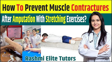 How to prevent muscle contractures after amputation with stretching exercises?