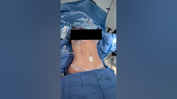 Mommy makeover by Dr. Lyly immediately post-op ❤️