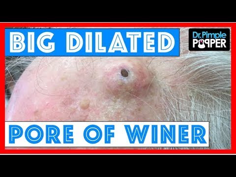 pimple popper blackhead