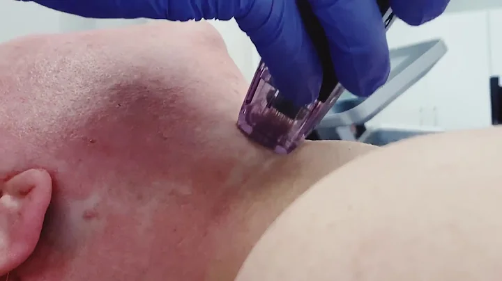 Morpheus8 (Radio-Frequency Micro-needling) to Face & Neck