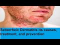 Understanding Seborrheic Dermatitis