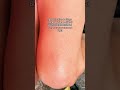 i only pay attention because i know how to help🩵tired of those tiny red bumps on your arms or legs?