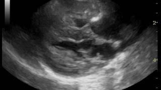 right long axis four-chamber view of the heart
