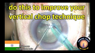 resident cataract surgery: improve your vertical chop technique