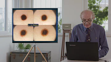 Che cos'è un nevo Displastico?