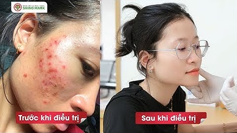 5 BUỔI CHUYÊN SÂU - DA SÁNG, MỊN, TỰ TIN tại phòng khám Da Liễu Bệnh viện Đại học Y Dược Shing Mark