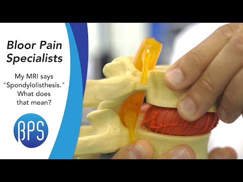 Videó: Mit jelent a spondylalgia szó?