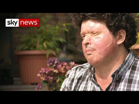 Acid victim 'sickened' after attacker's life sentence quashed