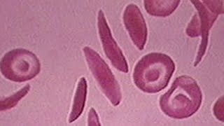 FDA approves first gene therapies to treat sickle cell disease | NewsNation Live