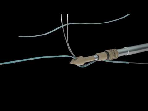 Double Row Rotator Cuff Repair Animation featuring HEALICOIL*, MULTIFIX* S ULTRA, and FIRSTPASS* ST