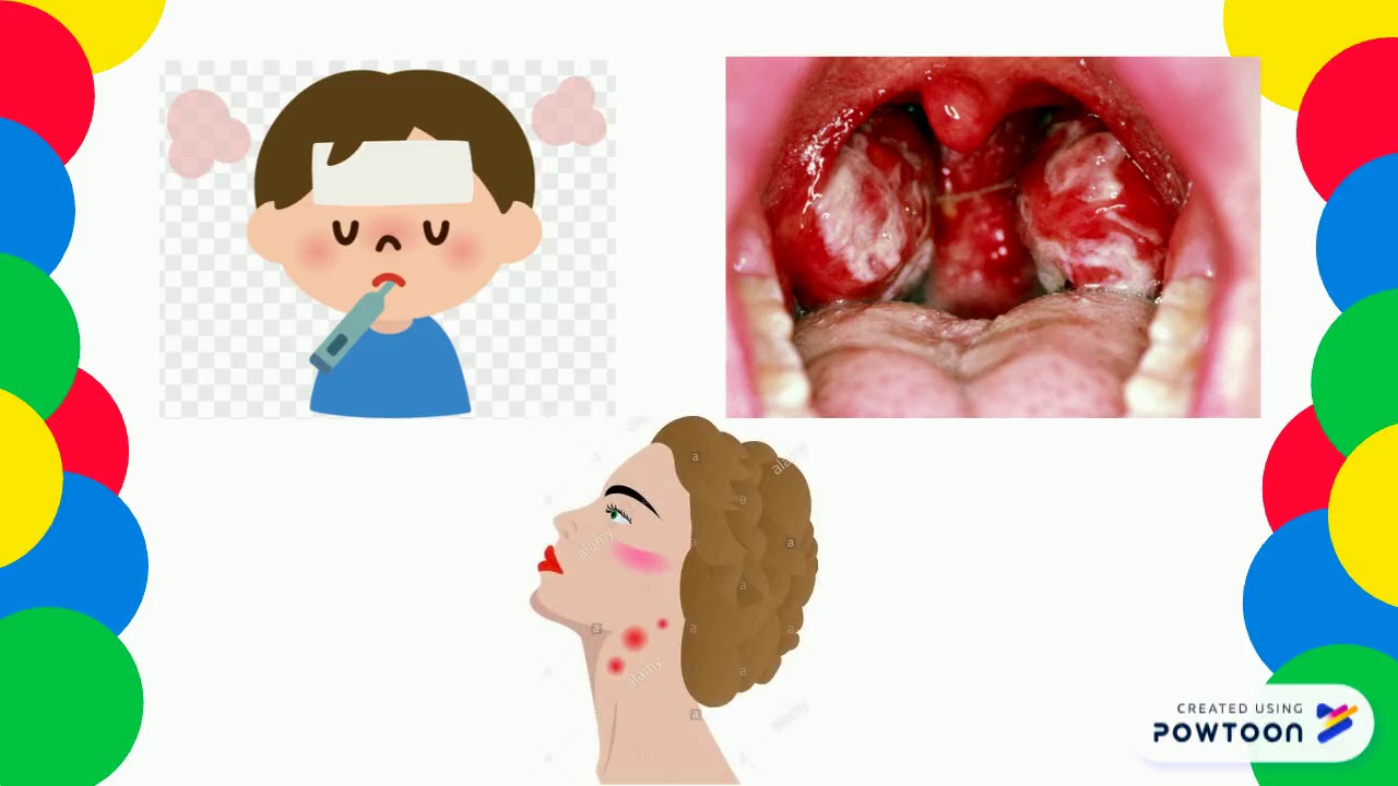 MONONUCLEOSIS INFECCIOSA POR EBV Y CMV YouTube MONONUCLEOSIS INFECCIOSA POR EBV Y CMV YouTube