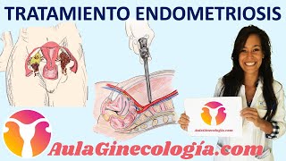TRATAMIENTO de la ENDOMETRIOSIS: analgésicos, anticonceptivos, cirugía.. - Ginecología y Obstetricia