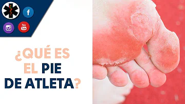 ¿Cómo deshacerse de los hongos en los pies en los zapatos?