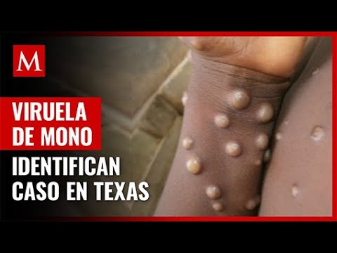 Identifican caso de viruela de mono en Texas