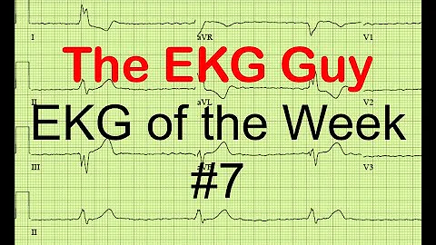 EKG/ECG of the Week #7 | The EKG Guy - www.ekg.md