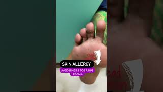 Skin Allergy to finger rings | Toe rings #shorts #drashimagoel #youtubeshorts #parisaskinclinic