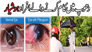 What is Pterygium( Nakhoona) ? Eye Tips and treat Urdu /Hindi  || eye irritation in summer