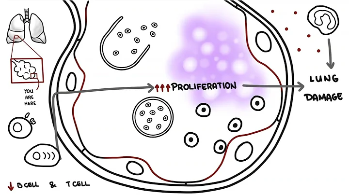 Pneumocystis jirovecii - Pneumocystis pneumonia