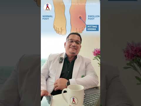 Pitting Edema Part 1 Pitting Edema Part 1