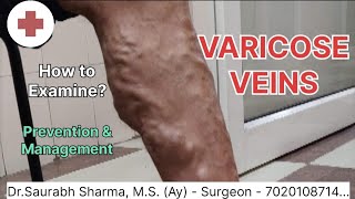 Examination of Varicose Veins | Dr.Saurabh Sharma | Patanjali Ayurveda | 7020108714