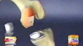 Partial Knee Replacement