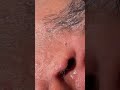 Big removal black head #skincare #skincareroutine #shorts