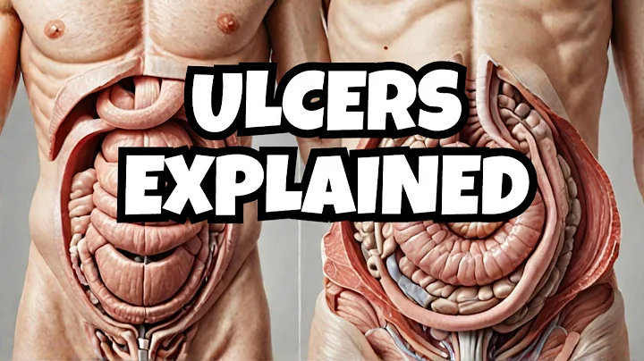 Stomach vs Duodenal Ulcers Explained | Symptoms, Causes, and Key Differences