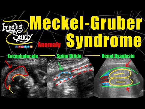 Meckel-Gruber Syndrome || Encephalocele | Spina Bifida | Renal Dysplasia || Anomaly || Case 268