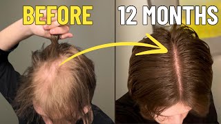 How to REALLY Stop Hair Loss (Full Guide with Results)