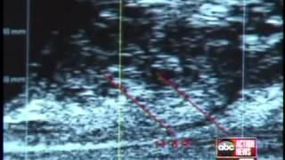 FDA ruling may reduce unnecessary prostate biopsies