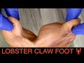 LOBSTER CLAW DEFORMITY: UPCOMING SURGERY **SEE IT TO BELIEVE IT!!!