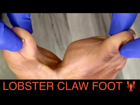 LOBSTER CLAW DEFORMITY: UPCOMING SURGERY **SEE IT TO BELIEVE IT!!!