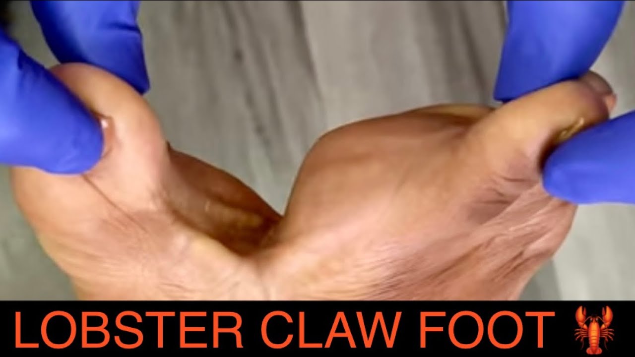 LOBSTER CLAW DEFORMITY UPCOMING SURGERY SEE IT TO BELIEVE IT lobster-claw-deformity-upcoming-surgery-see-it-to-believe-it