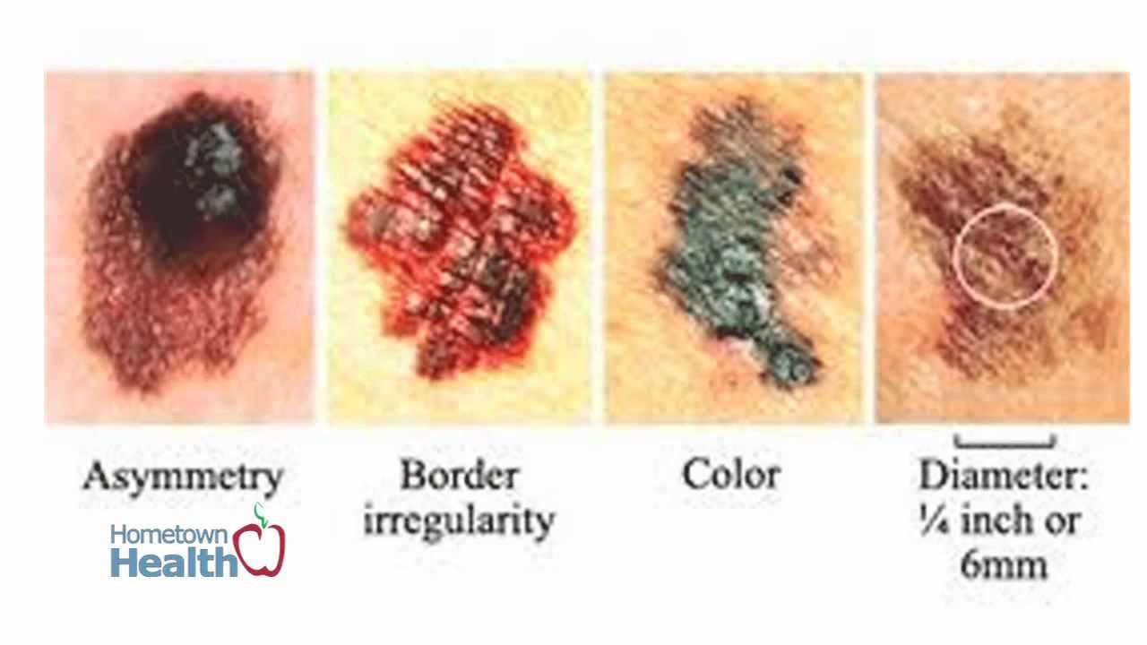 lake-ent-precancerous-skin-cells-youtube