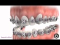 Removable bite plate with braces