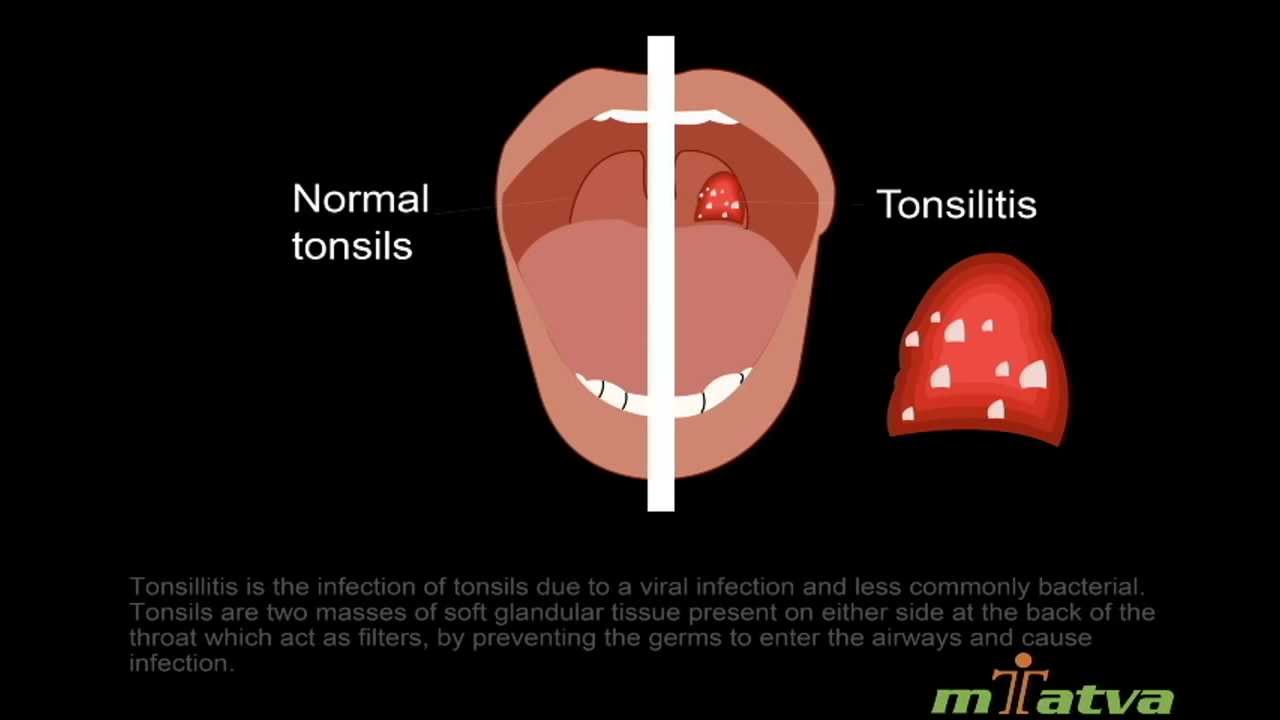 Tonsillitis Youtube