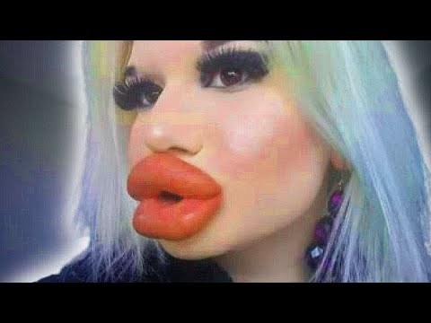 Why I Want The World's Biggest Lips - The Positivity Fix