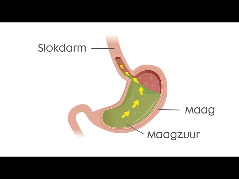 Video: Barrett's Slokdarm: Oorzaken, Risicofactoren En Symptomen