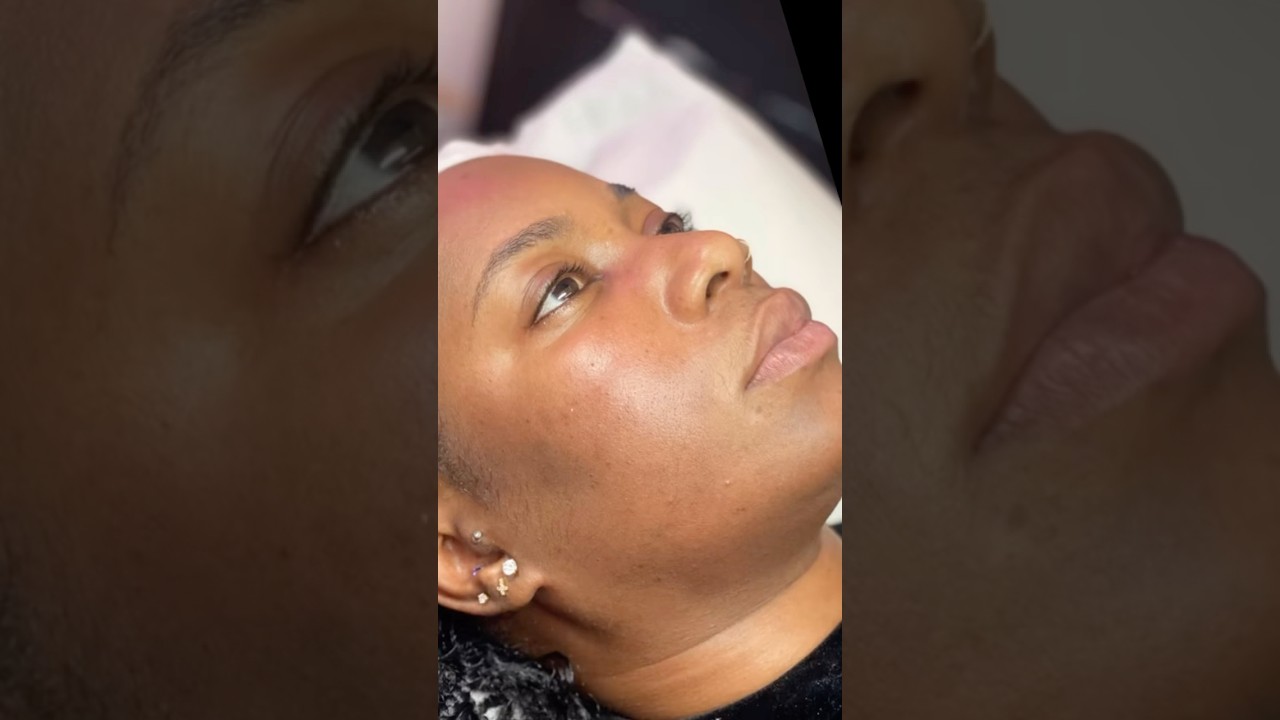 Bio Peeling Treatment | Before & After | Hyperpigmentation & Scarring Treatment