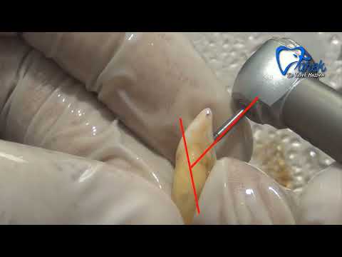 Access opening of maxillary central incisor | Dr Tarek Hussien