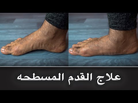فيديو: 3 طرق لإصلاح الأقدام المسطحة