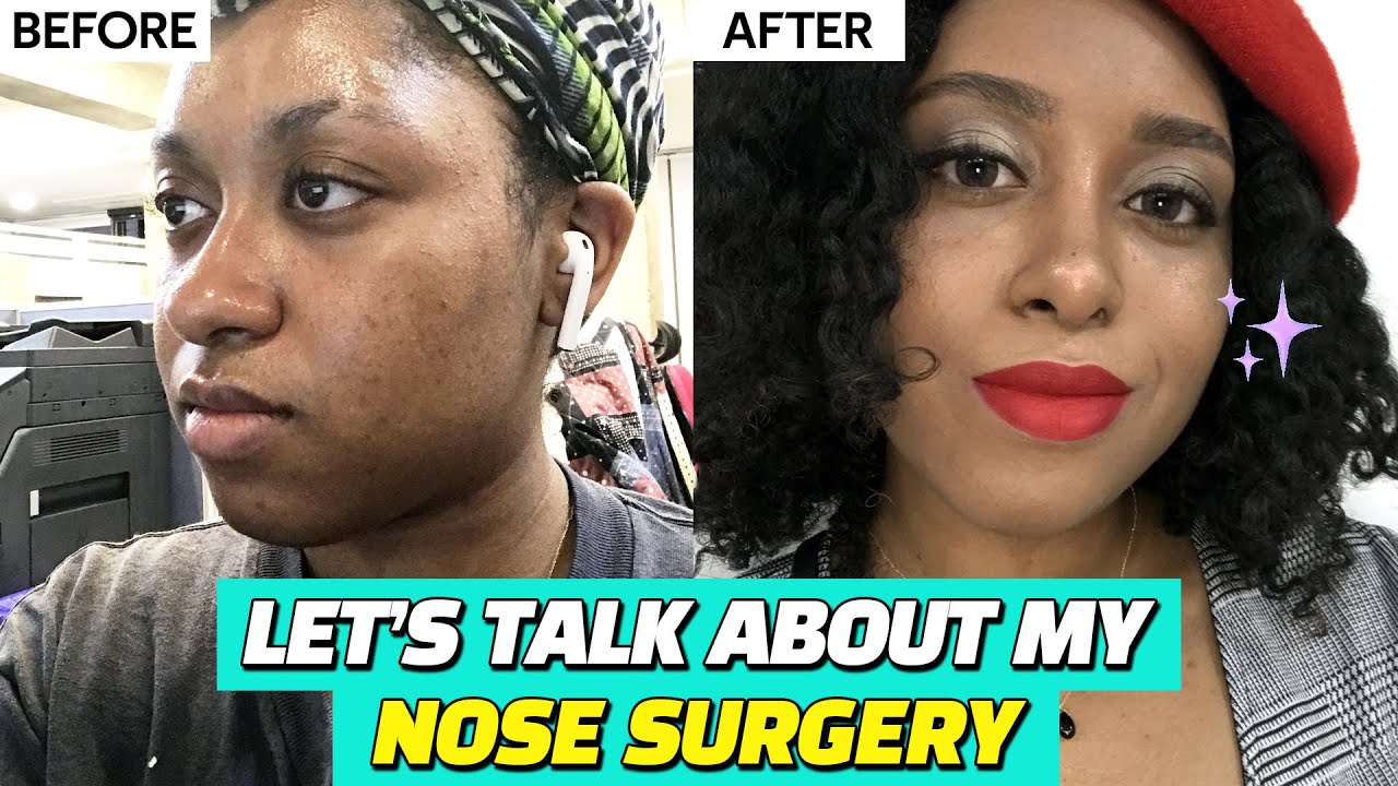 Let's Talk about My Nose Job | Arrow Nose + Alar Reduction + Implant + Nose Tip