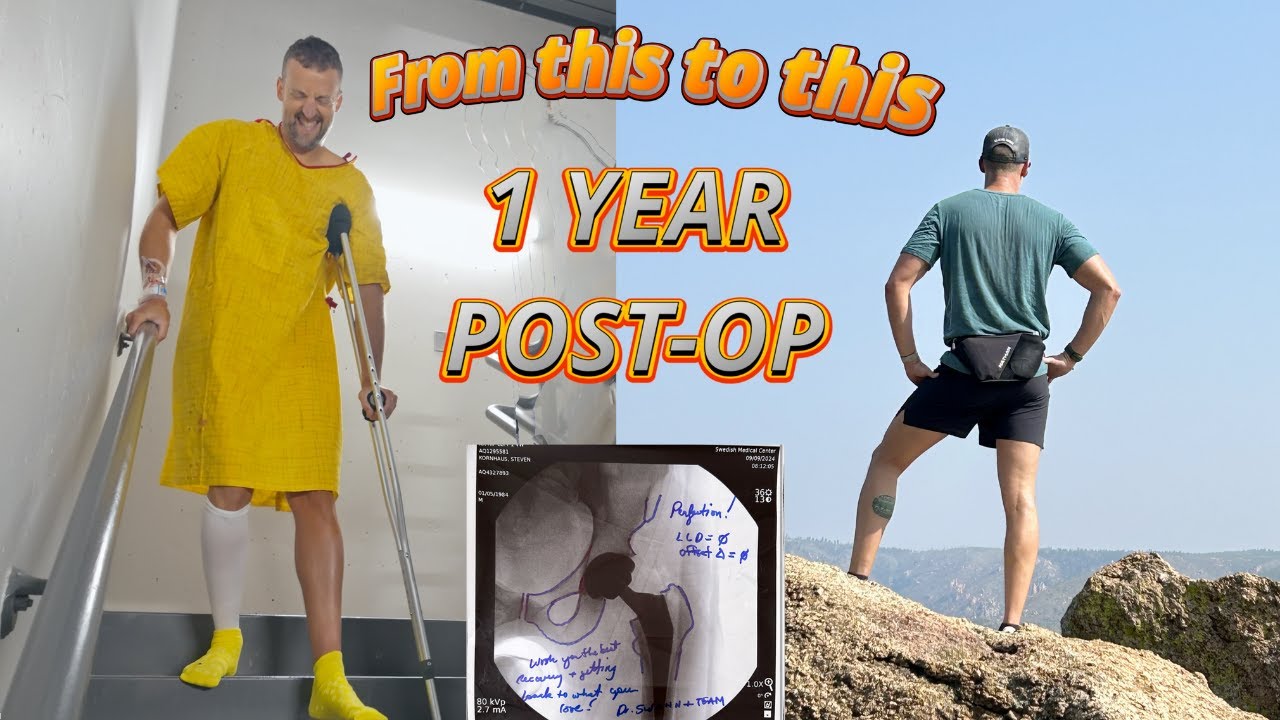 Total Hip Replacement Recovery / 1 Year Later / Would I do it Again? Ep.12