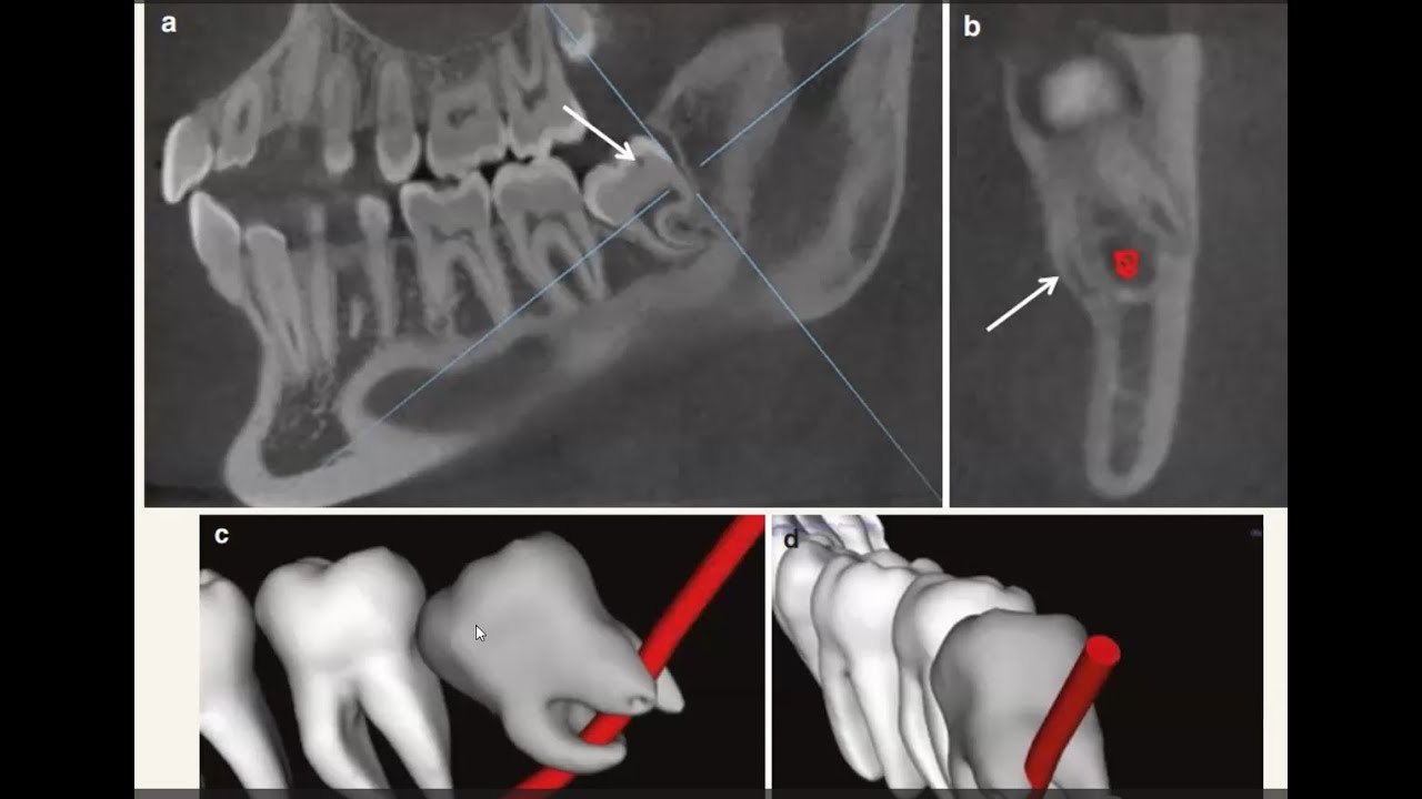 CBCT Navigation using Ondemand Software Part 1
