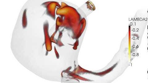 Unstable flow in an MCA aneurysm II