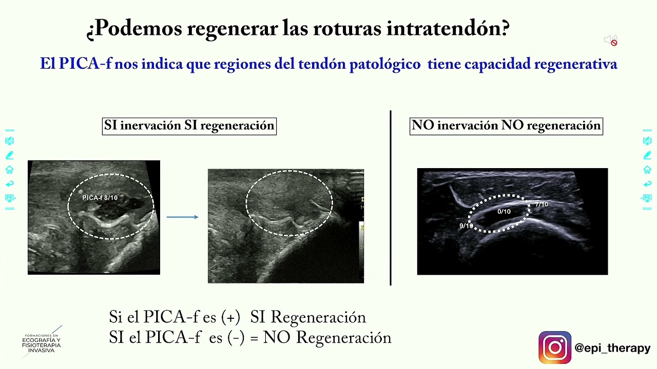 Técnica de Micro EPI®