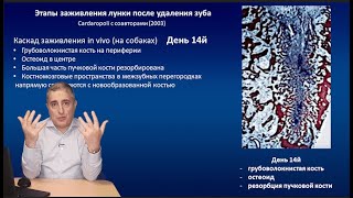 Удаление зуба / Заживление / Имплантация / Часть 1 / Руководство для врачей