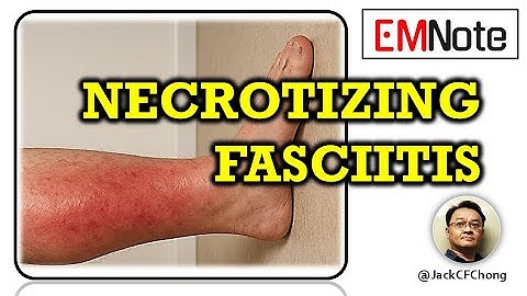 Necrotizing Fasciitis