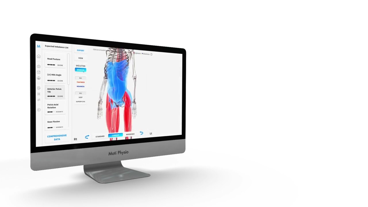 Moti Physio software – tight muscles in red, weak muscles in blue